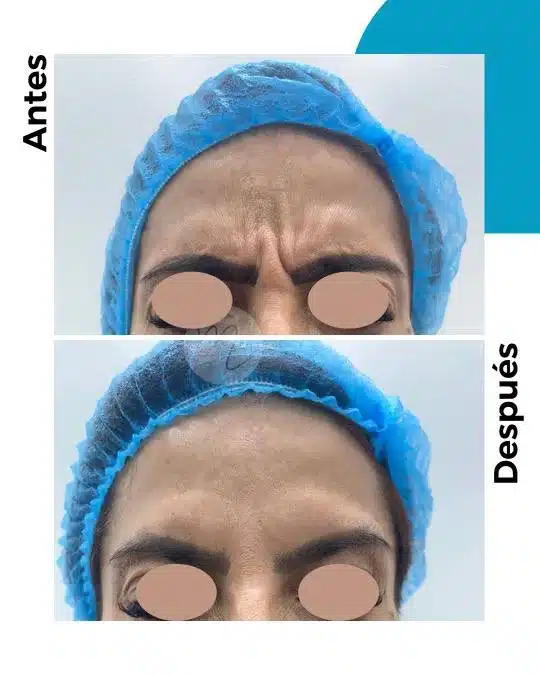 antes-y-despues-toxina-botulinica_1