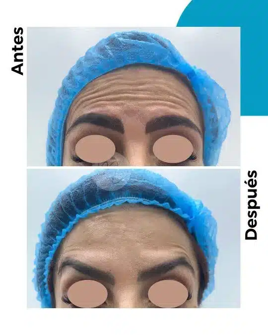 antes-y-despues-toxina-botulinica_2