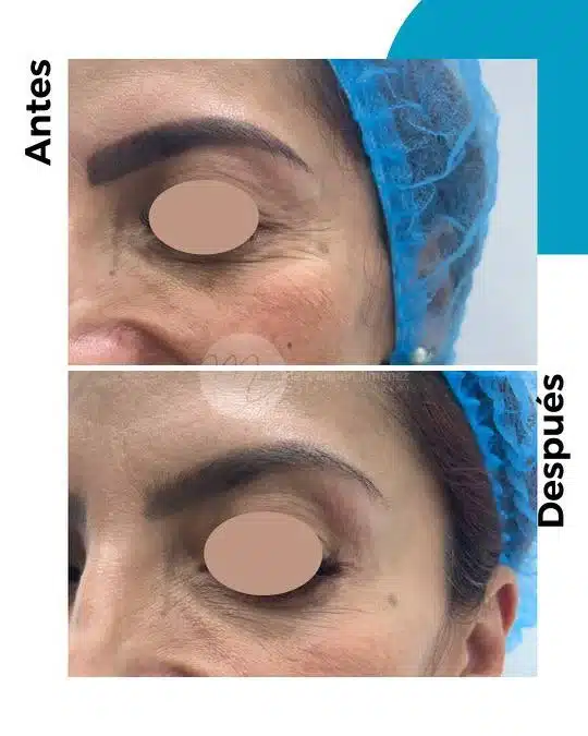 antes-y-despues-toxina-botulinica_2