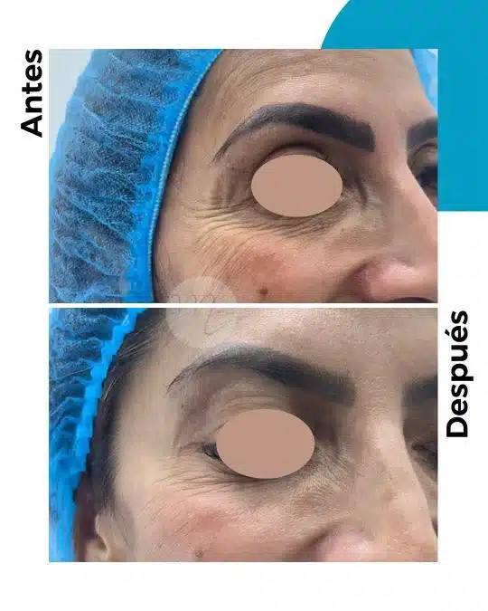 antes-y-despues-toxina-botulinica_3