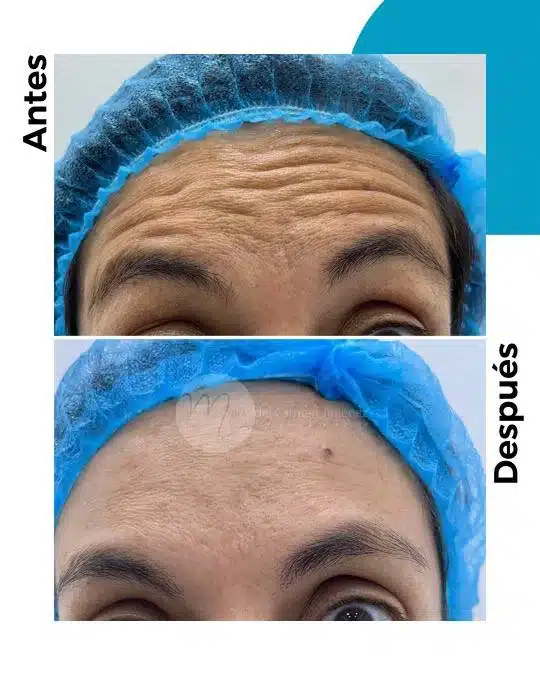 antes-y-despues-toxina-botulinica_4
