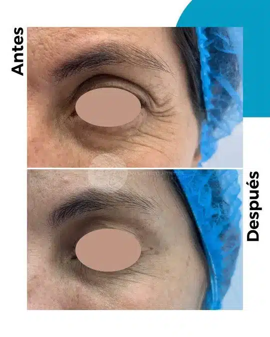 antes-y-despues-toxina-botulinica_6