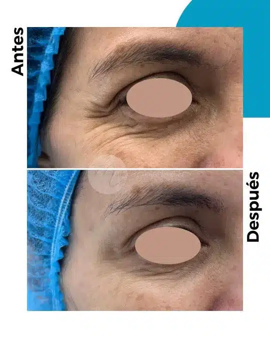 antes-y-despues-toxina-botulinica_7