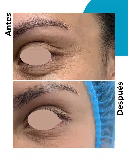 antes-y-despues-toxina-botulinica_8