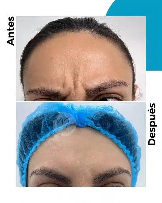 antes-y-despues-toxina-botulinica_10