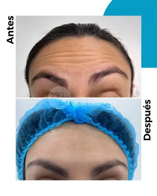 antes-y-despues-toxina-botulinica_