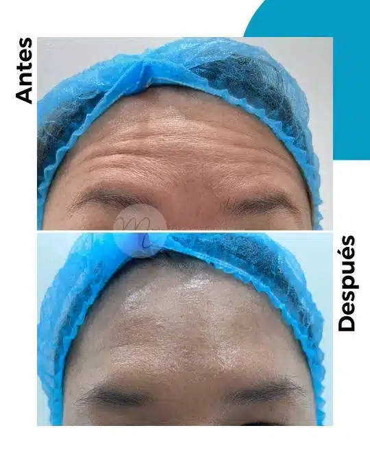 antes-y-despues-toxina-botulinica_11