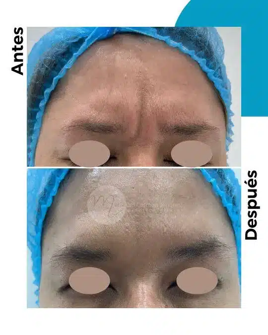 antes-y-despues-toxina-botulinica